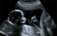 गर्भावस्था के दौरान भ्रूण की हलचलें कब शुरू होती हैं और उन्हें कैसे पहचानें?