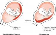 Low placentation during pregnancy at 20-21 weeks