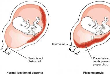Nízka placentácia počas tehotenstva v 20-21 týždni