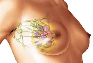 Liečba mastopatie prsníka