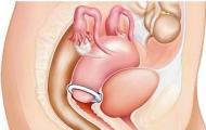 Inel pe colul uterin în timpul sarcinii: întregul adevăr despre pesarul pentru viitoarele mame