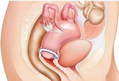 Cervikálny krúžok počas tehotenstva: celá pravda o pesaroch pre nastávajúce matky